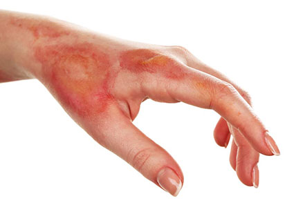 خطرات آمونیاک برای پوست